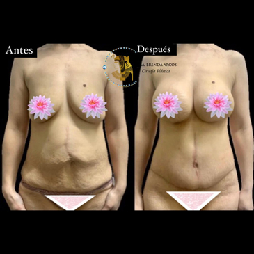 Slider image (3) Dra. Brenda Arcos Vera Cirugia Plastica